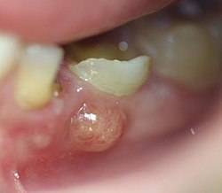 طرق طبيعية في علاج خراج الضرس 