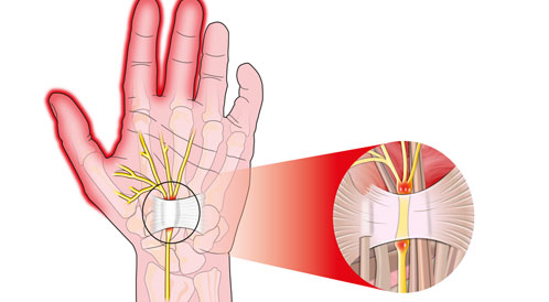 أفضل طرق علاج تصلب الاعصاب
