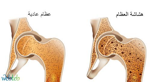 أقوى وصفات علاج هشاشة العظام